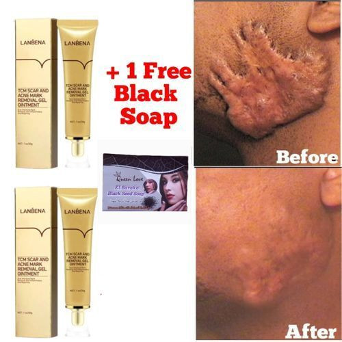 Acne Scar Stretch Marks Keloids Pimples Black Dark Spots Remover Burns Treatment Skin Care Repair Gel Cream 30g X 2Pcs Plus 1 Free Black Soap